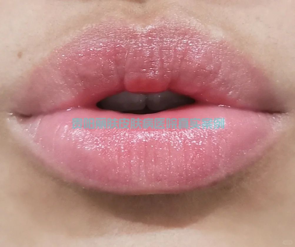 唇炎案例