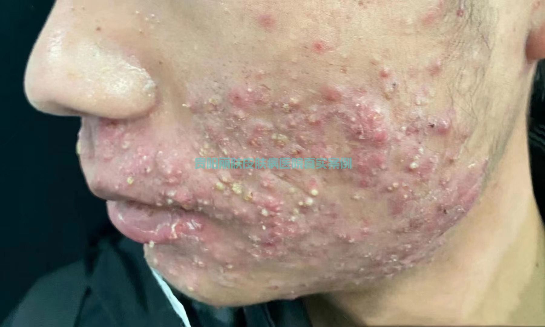 痤疮案例