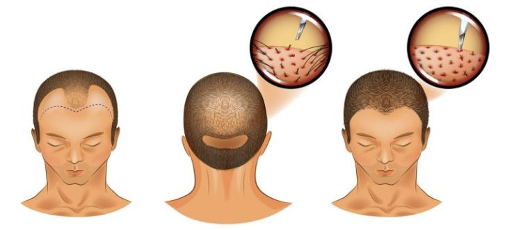 植发能维持多久，有后遗症和副作用吗？先看完这篇科普再决定！