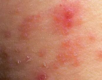 丽肤说：盛夏虽好，要注意皮肤别被湿疹烦恼！